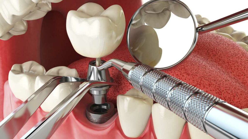 como funciona o implante dentário